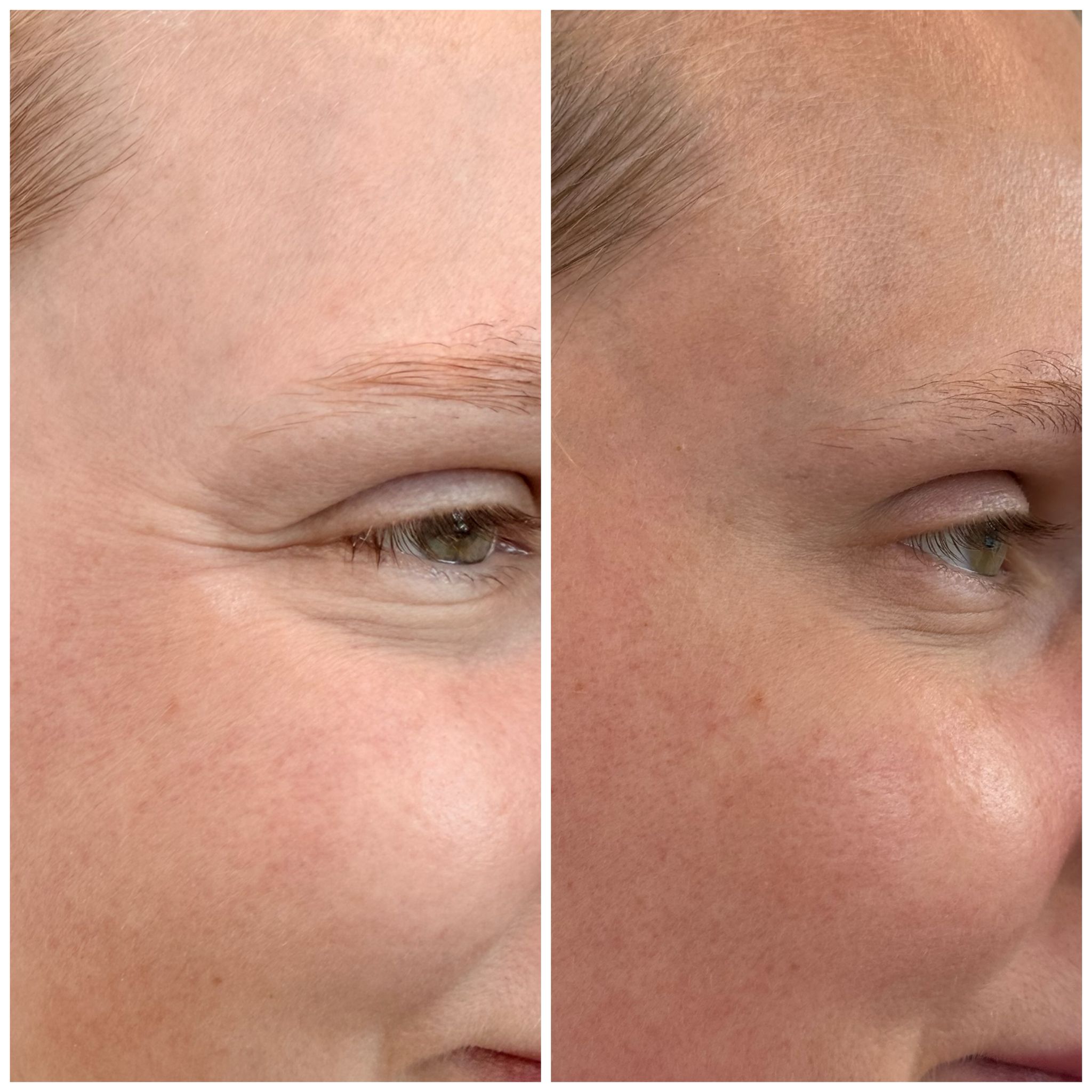 Mintus treatment before and after result 3