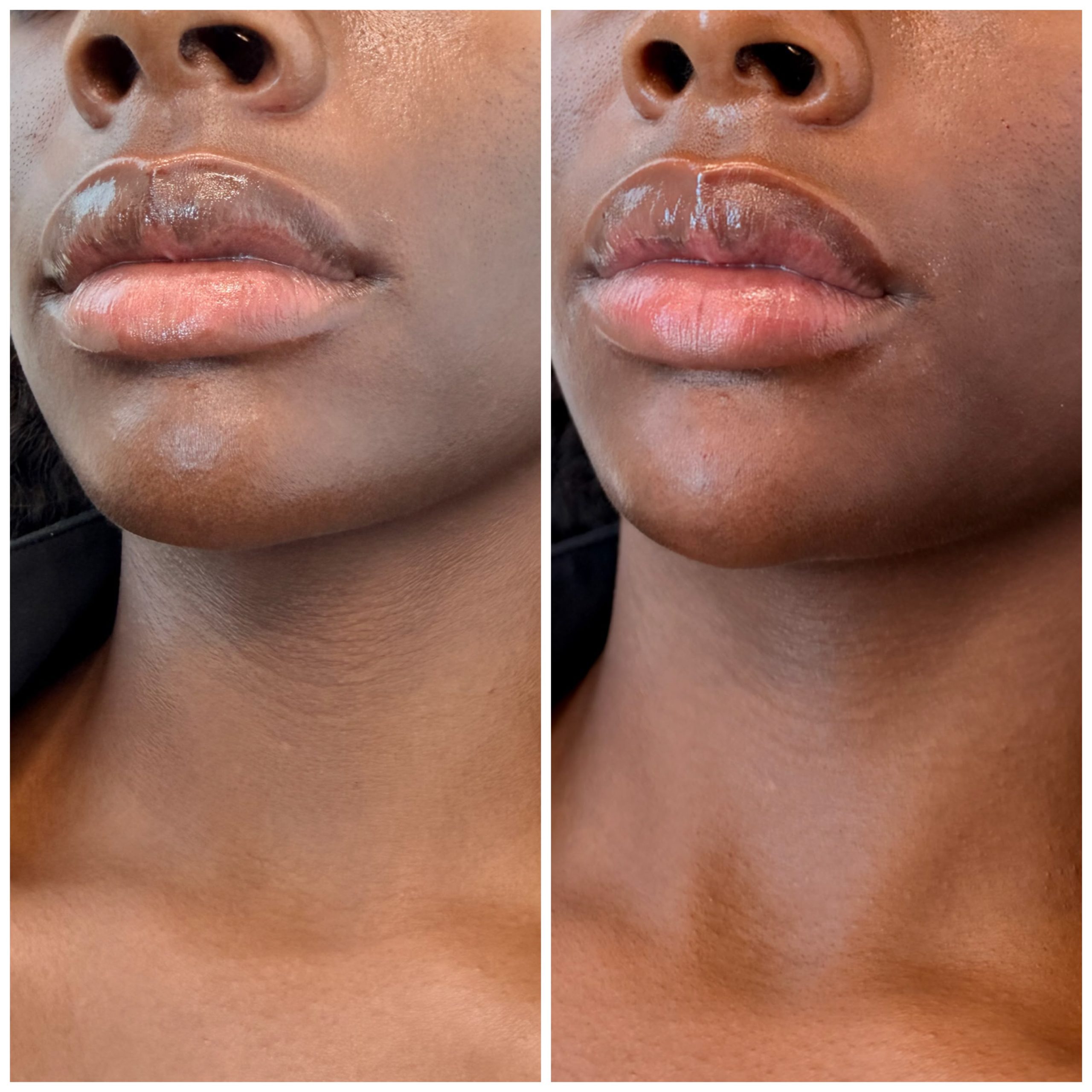 Mintus treatment before and after result 5