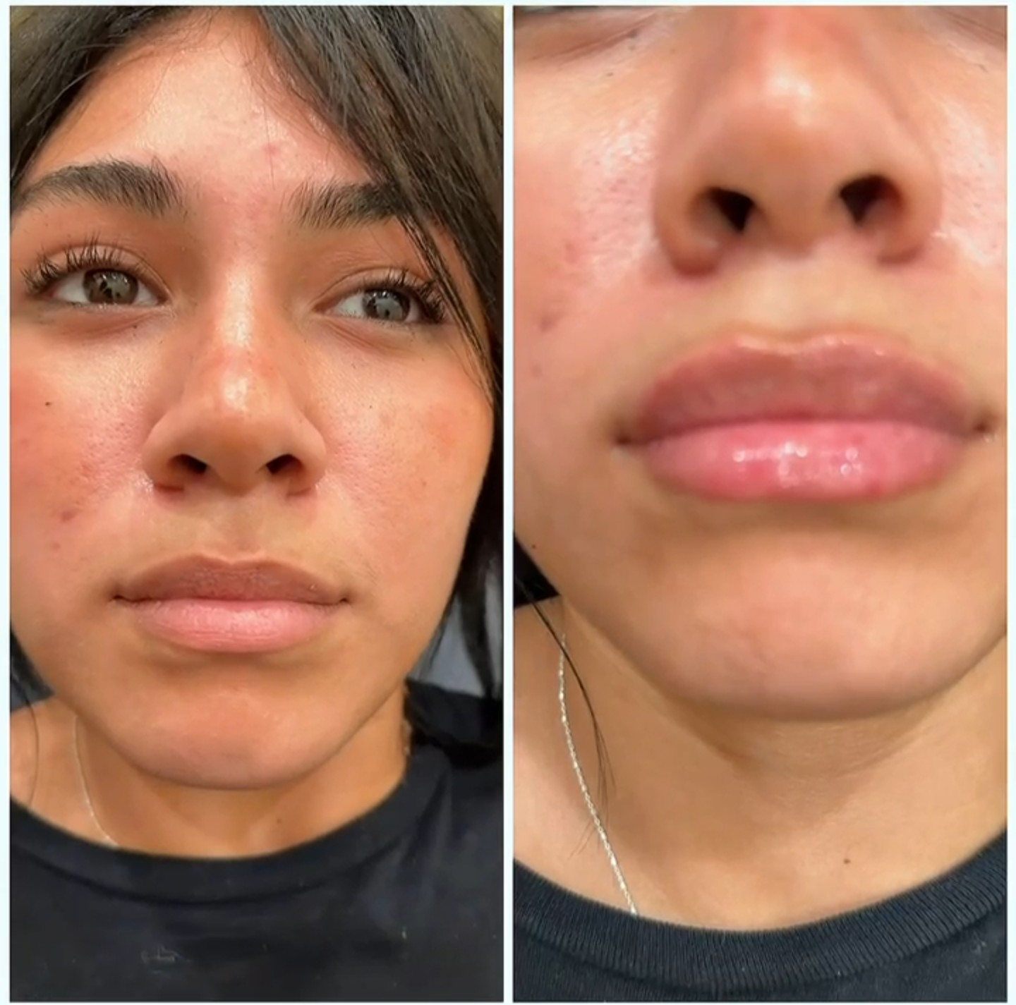 Mintus treatment before and after result